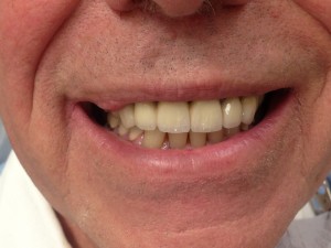 Before and after: front dental bridge (after)