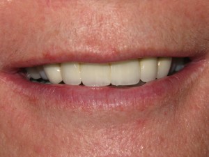 After treatment - Front Bridge