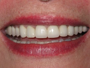 After treatment - Six crowns - chipped teeth