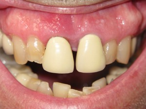 Before and after: front dental bridge (before)
