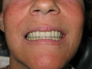 Before and after: anterior open bite correction (after)