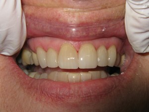 Before and after: restoration of the six front teeth (after)