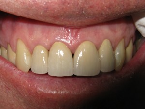 Before and after: full smile restoration (after)