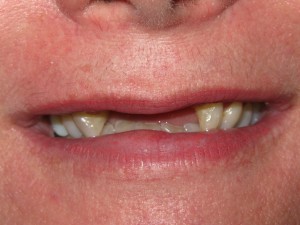 Before treatment - Front Bridge