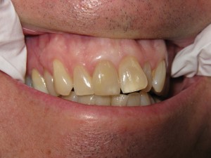 Before and after: crown restoration (after)