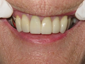 After treatment - Six crowns - abfraction repair