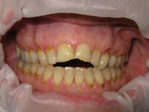 Before and after: anterior open bite correction (before)