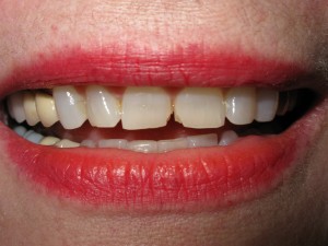 Before treatment - Six crowns - chipped teeth
